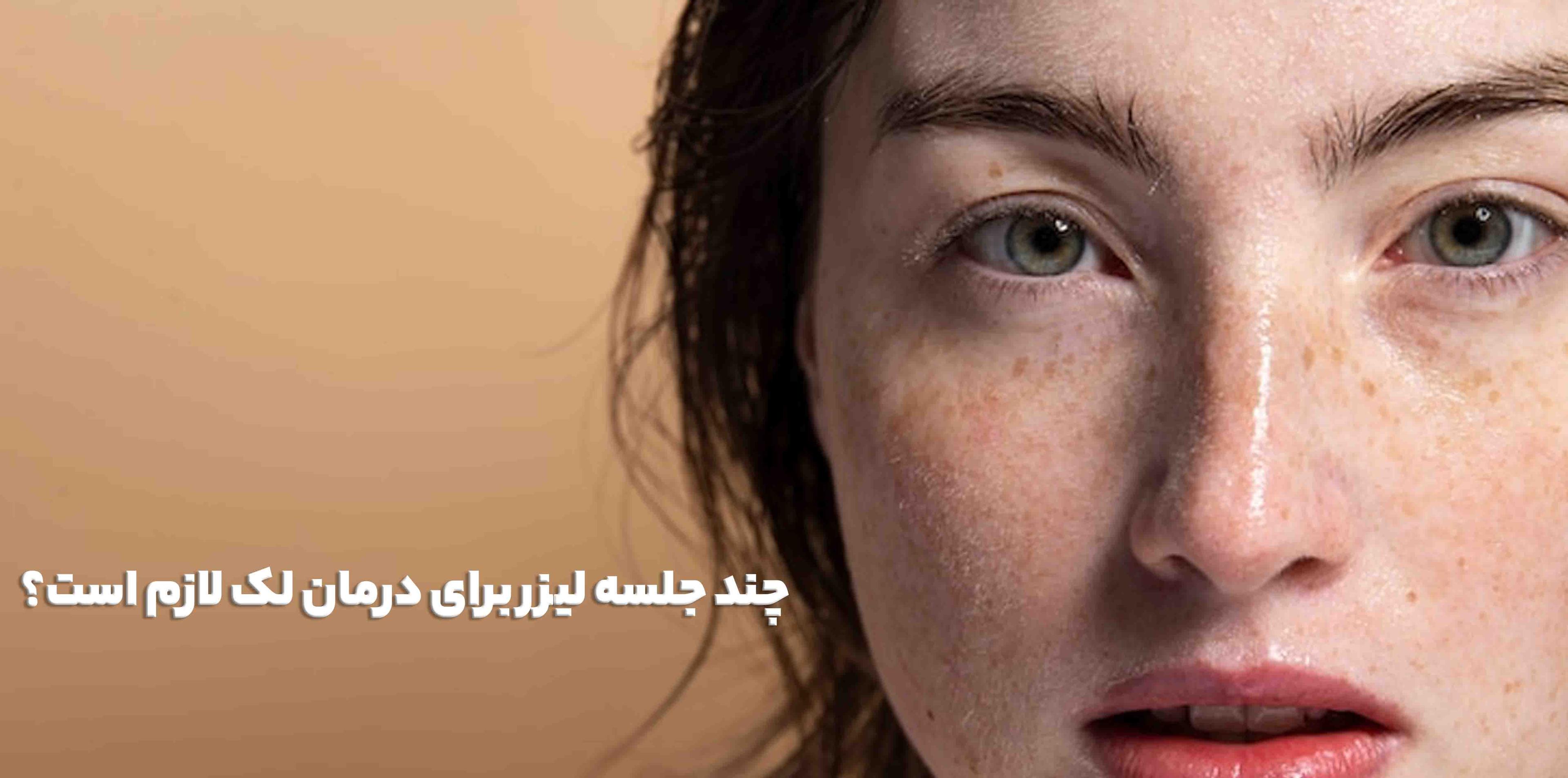چند جلسه لیزر برای درمان لک لازم است؟