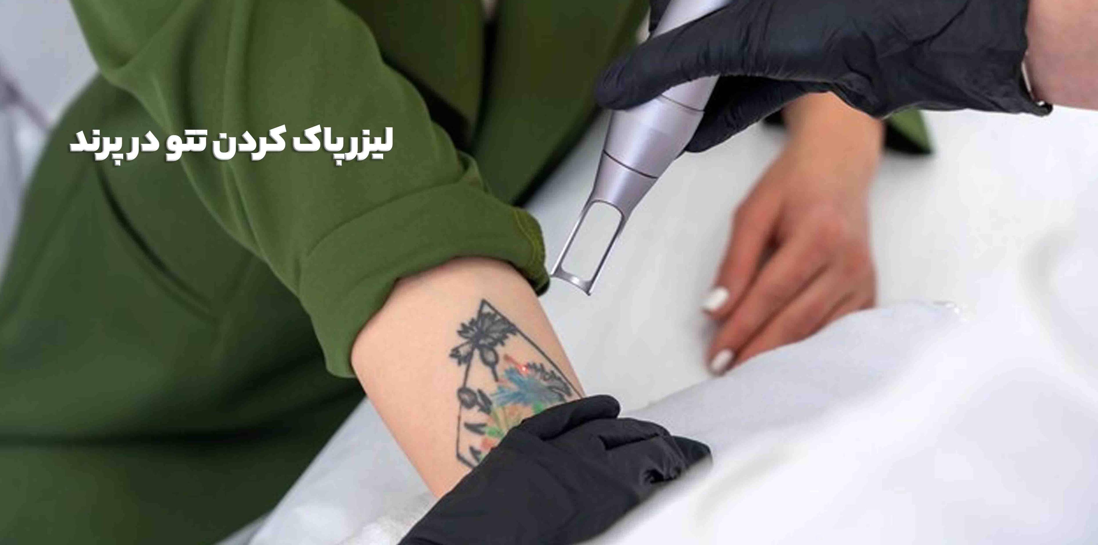 لیزر پاک کردن تتو در پرند
